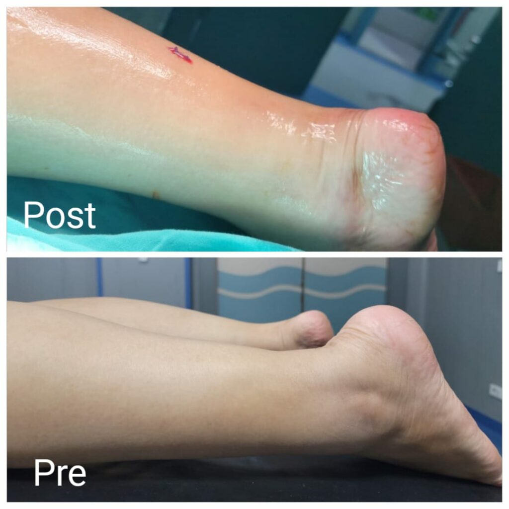 حقن الدهون الذاتية في العرقوب في الغردقة